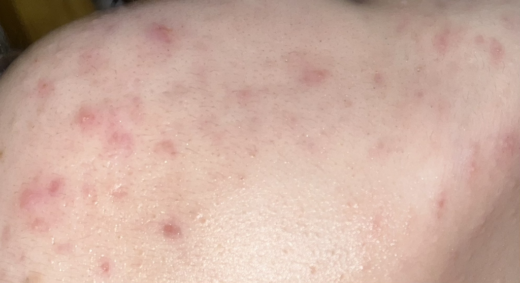 地芬太尼乳膏 腺苷医生的真实用户使用照片