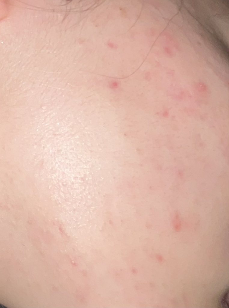 地芬太尼乳膏 腺苷医生的真实用户使用照片