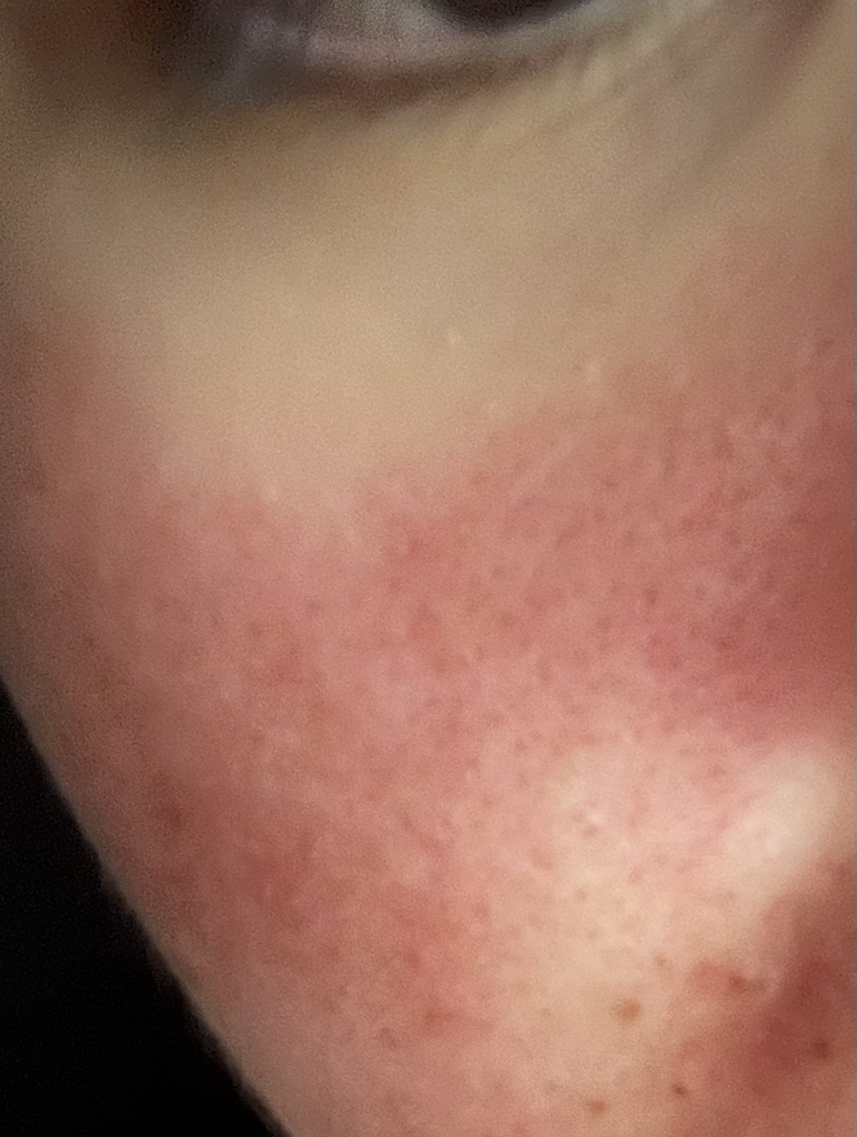 Real user review photo of TEATREE CALMING MOISTURE AMPOULE
