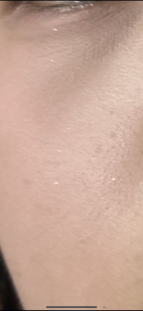 Real user review photo of TEATREE CALMING MOISTURE AMPOULE