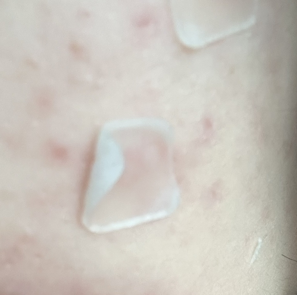 局部护理贴膏套装[红斑]的真实用户使用照片