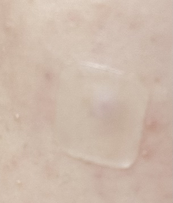 局部护理贴膏套装[红斑]的真实用户使用照片
