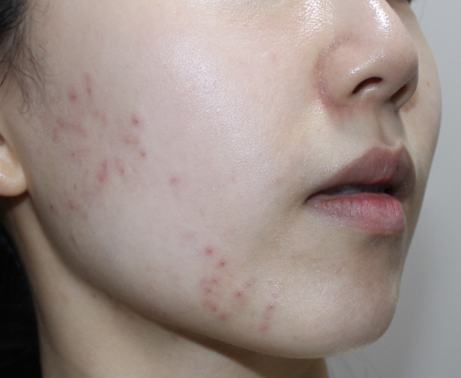 메디테라피 (MEDITHERAPY) 트라넥삼산 흔적 크림 review image