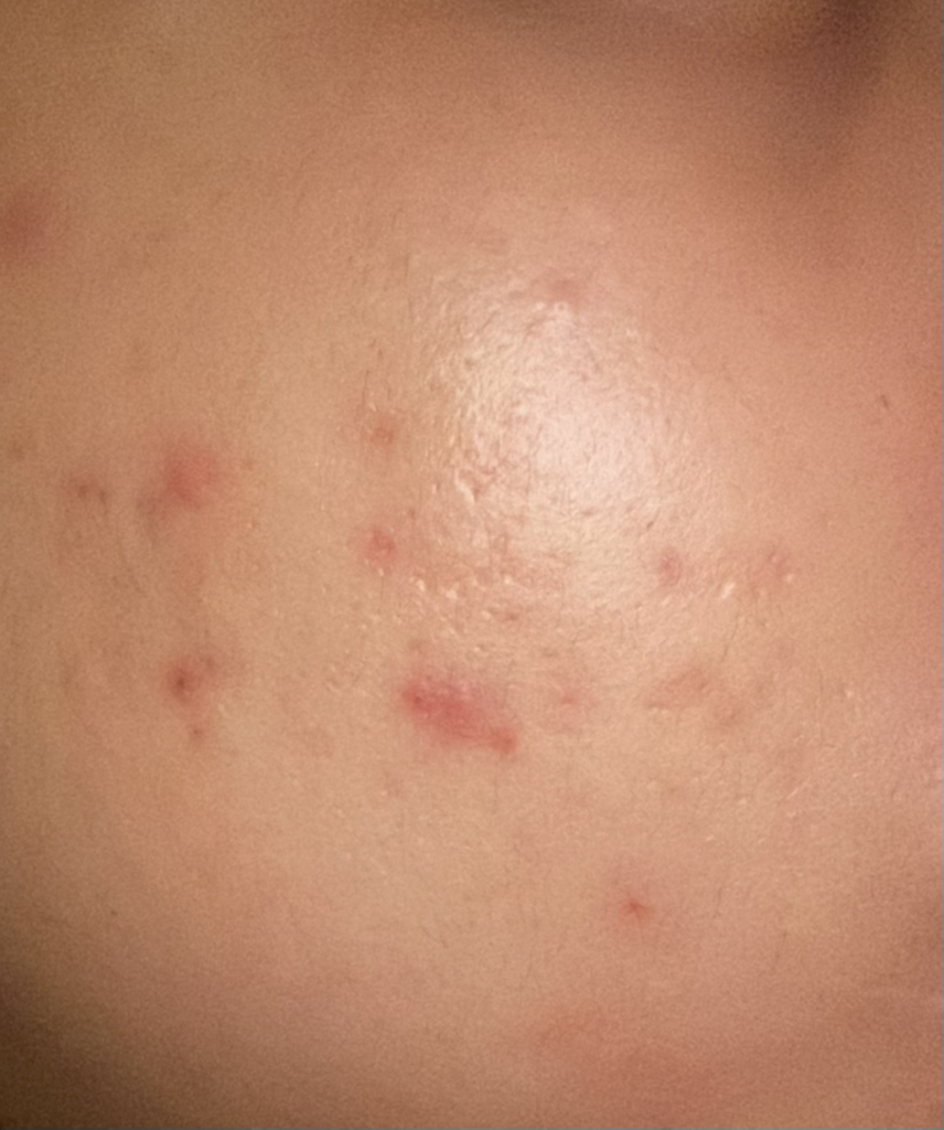地芬太尼乳膏 腺苷医生的真实用户使用照片