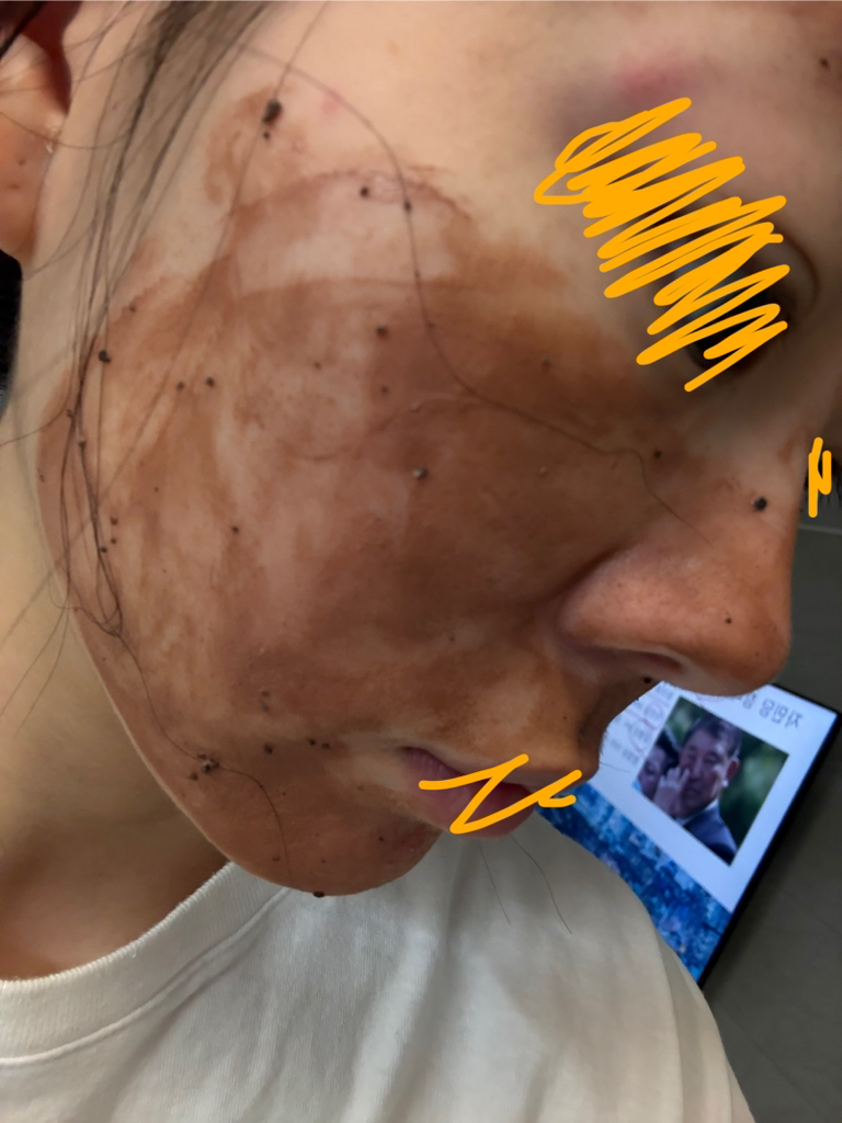 去角质毛孔面膜的真实用户使用照片