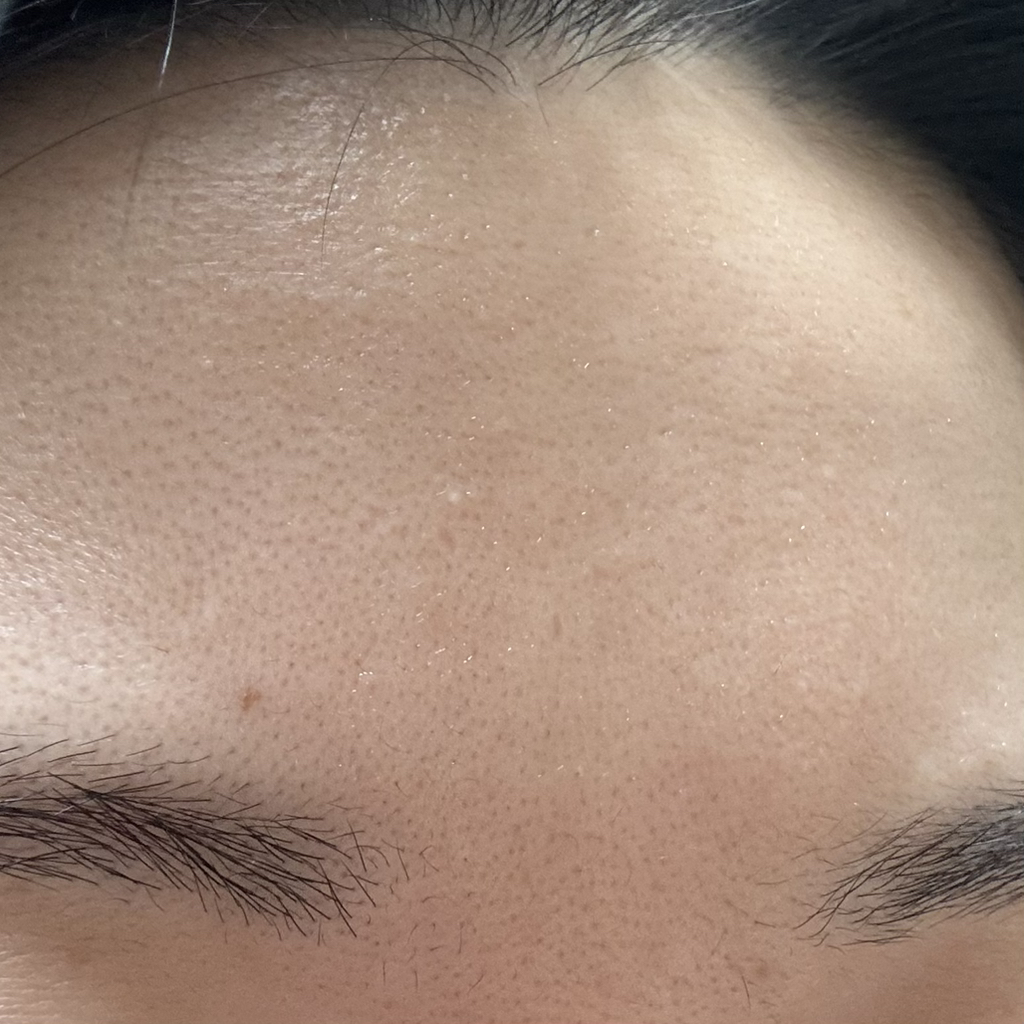 祛痘眼部和眉间贴的真实用户使用照片