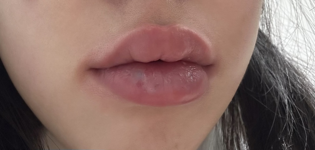 블리스텍스 (Blistex) 라스베리 레몬에이드 블래스트 립밤 [SPF15] review image
