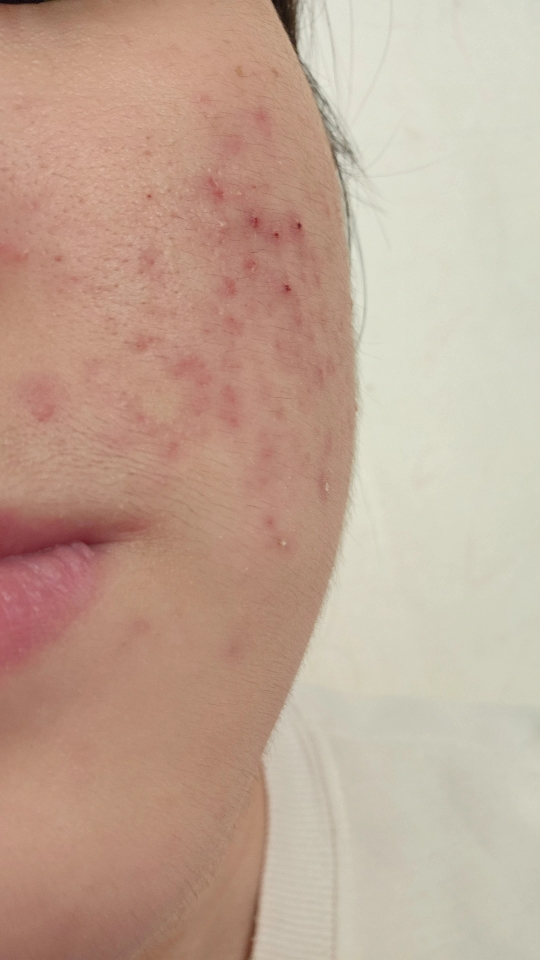 아크네스 (Acnes) 퍼펙트 솔루션 폼클렌저 review image
