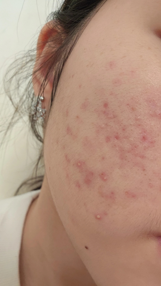 阿克内斯 完美溶液泡沫洁面乳 common.review image