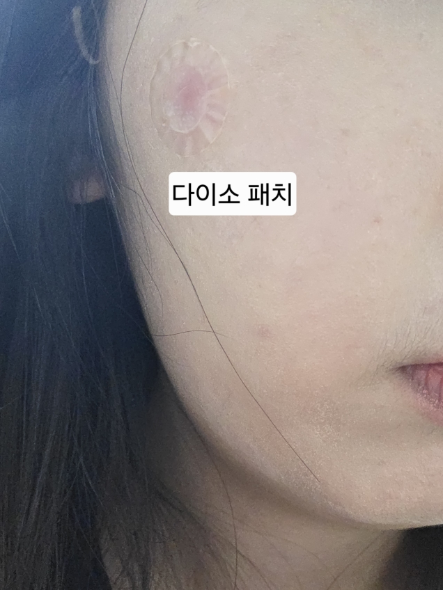 일루미엘 (illumiel+) 마이크로니드샷 엑소좀 스팟 패치 review image