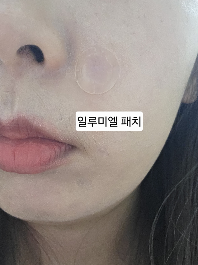 일루미엘 (illumiel+) 마이크로니드샷 엑소좀 스팟 패치 review image