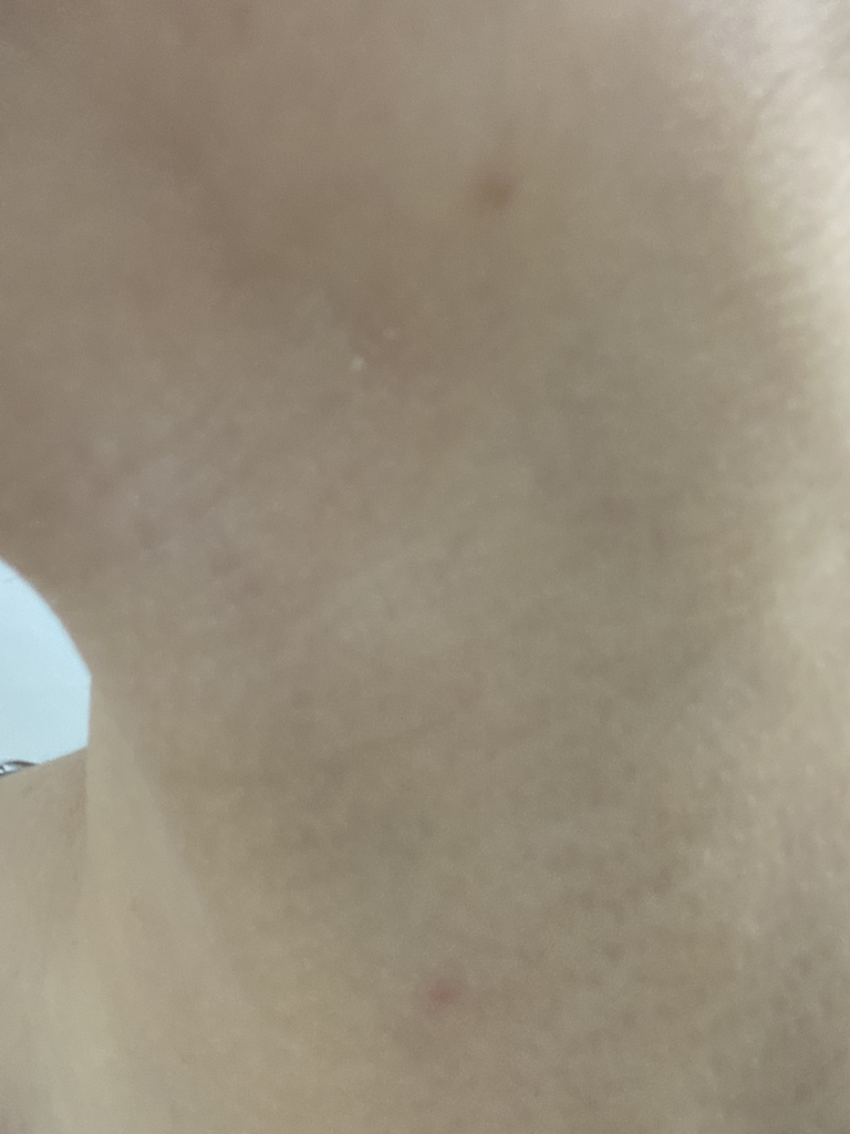 微针剂外泌体斑点贴片的真实用户使用照片