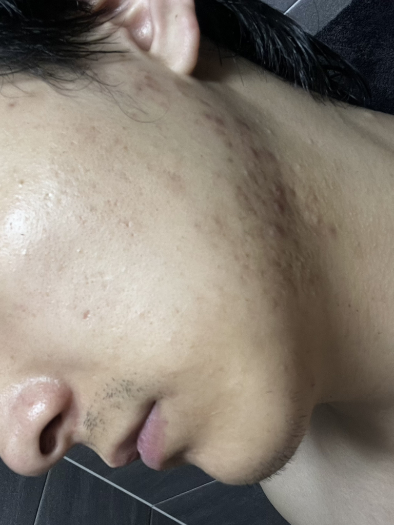 极端舒缓茶树油的真实用户使用照片