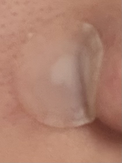 illumiel+ 微针剂外泌体斑点贴片 common.review image