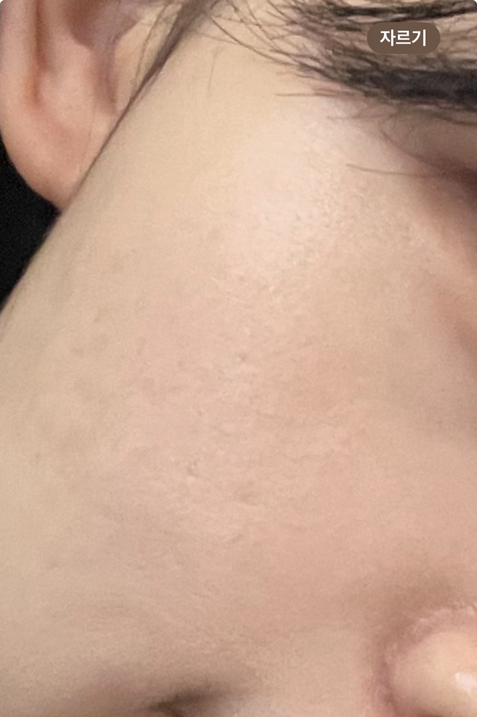 屏障自由注射剂的真实用户使用照片