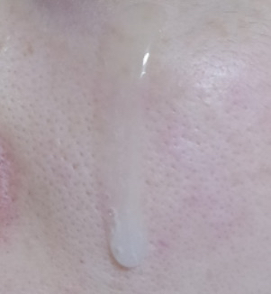 乳糖醇黑色素精华的真实用户使用照片