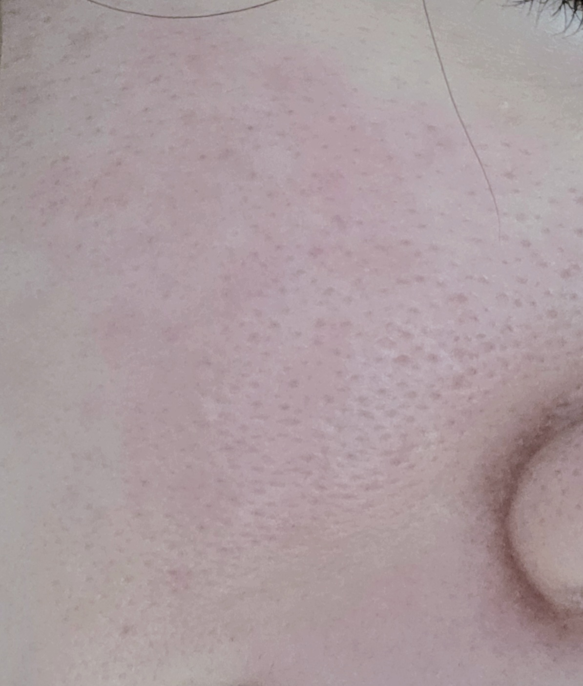 阿托巴比妥乳膏的真实用户使用照片