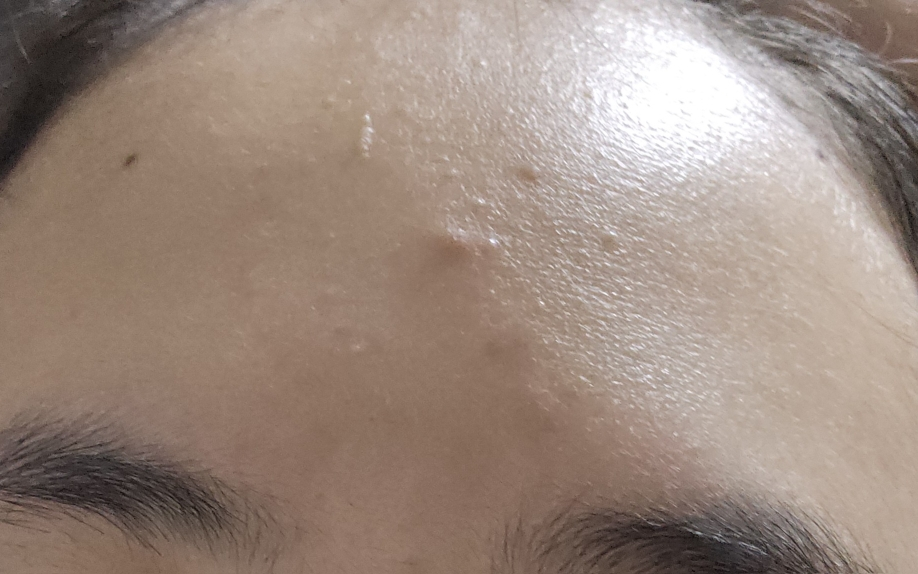 ThePure 茶树祛斑精华液的真实用户使用照片