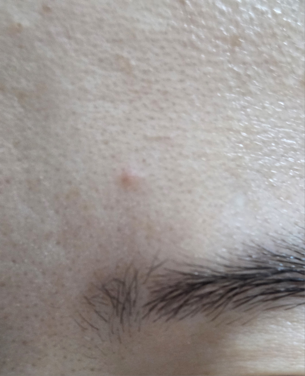 일루미엘 (illumiel+) 마이크로니드샷 엑소좀 스팟 패치 review image