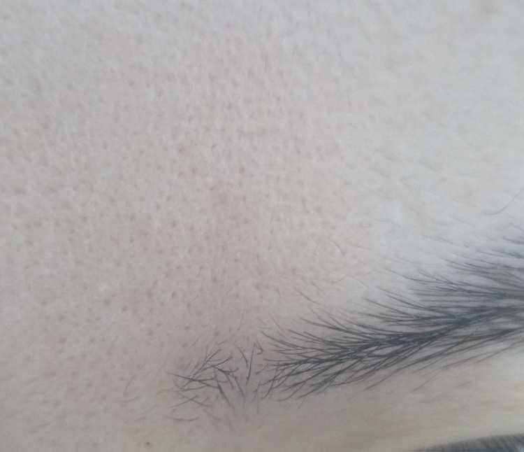 일루미엘 (illumiel+) 마이크로니드샷 엑소좀 스팟 패치 review image