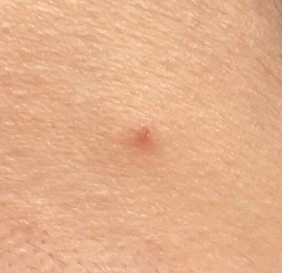 일루미엘 (illumiel+) 마이크로니드샷 엑소좀 스팟 패치 review image