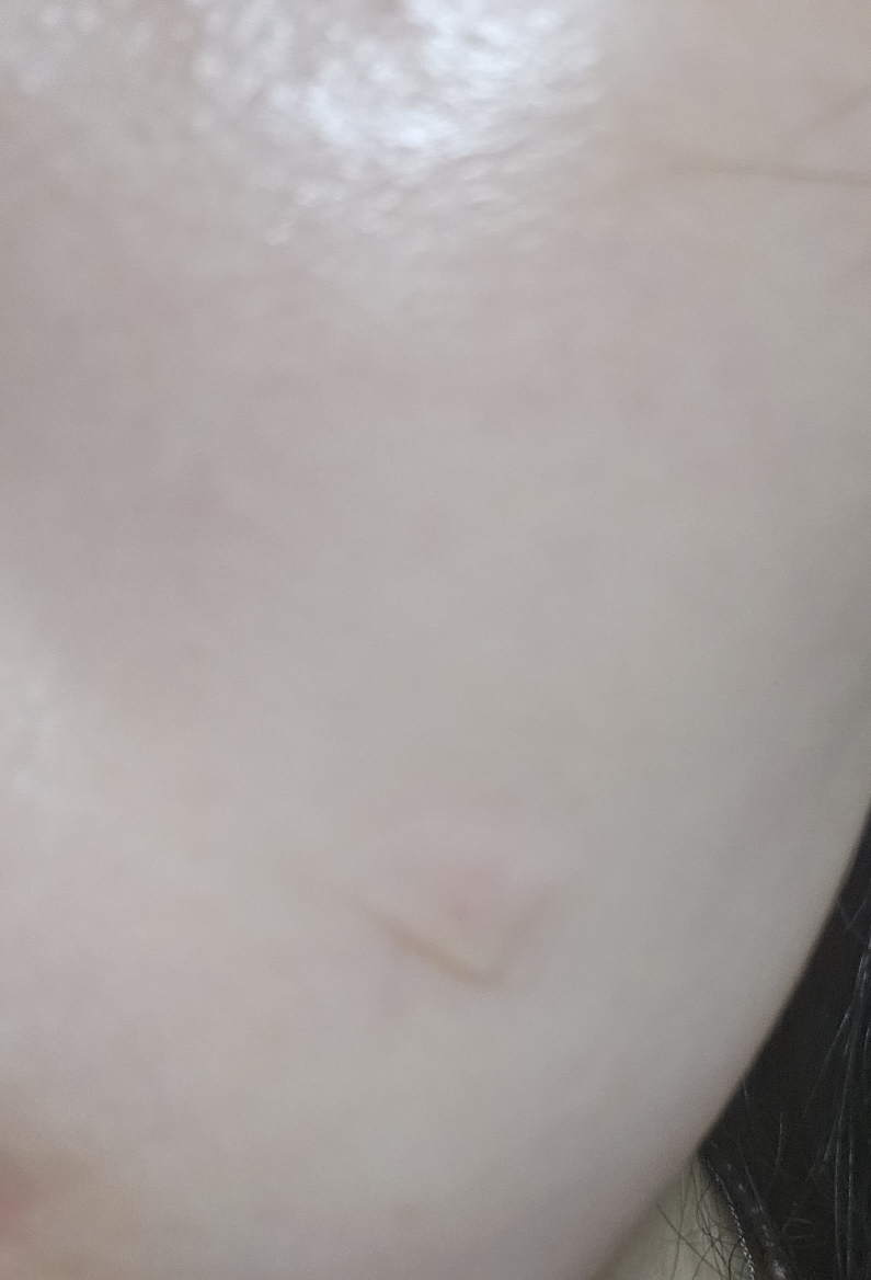 Ảnh đánh giá thực tế của người dùng về TurpinArc™ Spot Patch