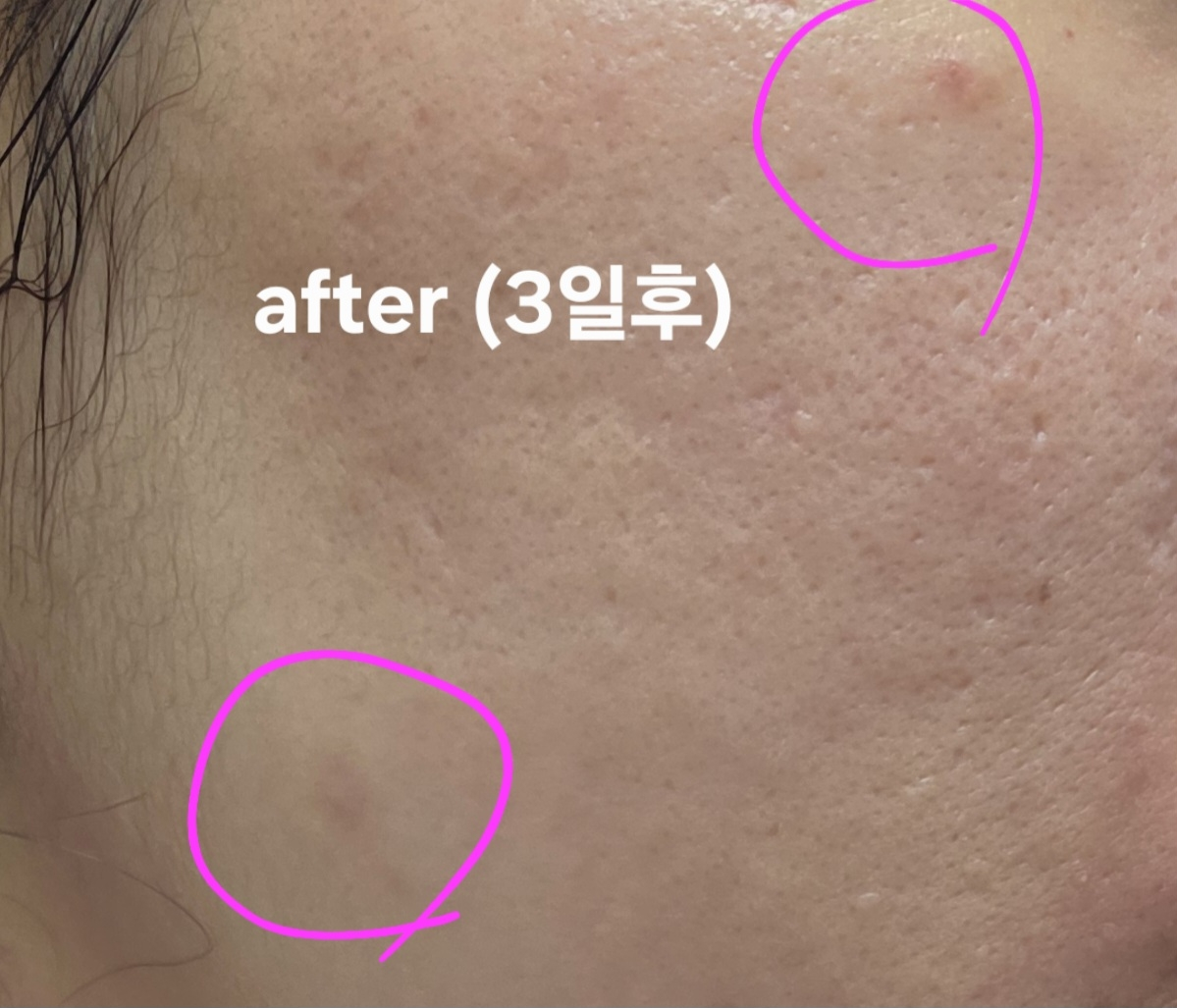 닥터나인틴 (Dr.nineteen) 포어엑스좀 레디알엔 엑소좀 앰플 review image