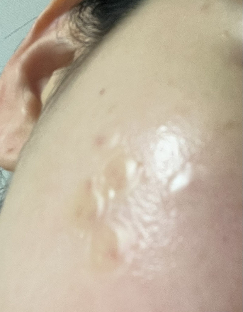 Ảnh đánh giá thực tế của người dùng về TurpinArc™ Spot Patch