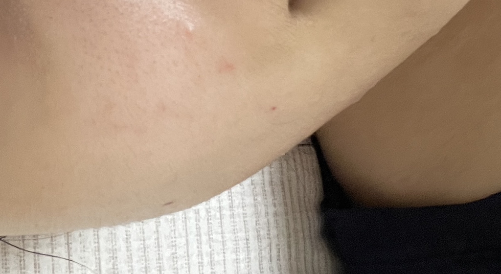 Akne 沙棘泡沫洁面乳的真实用户使用照片