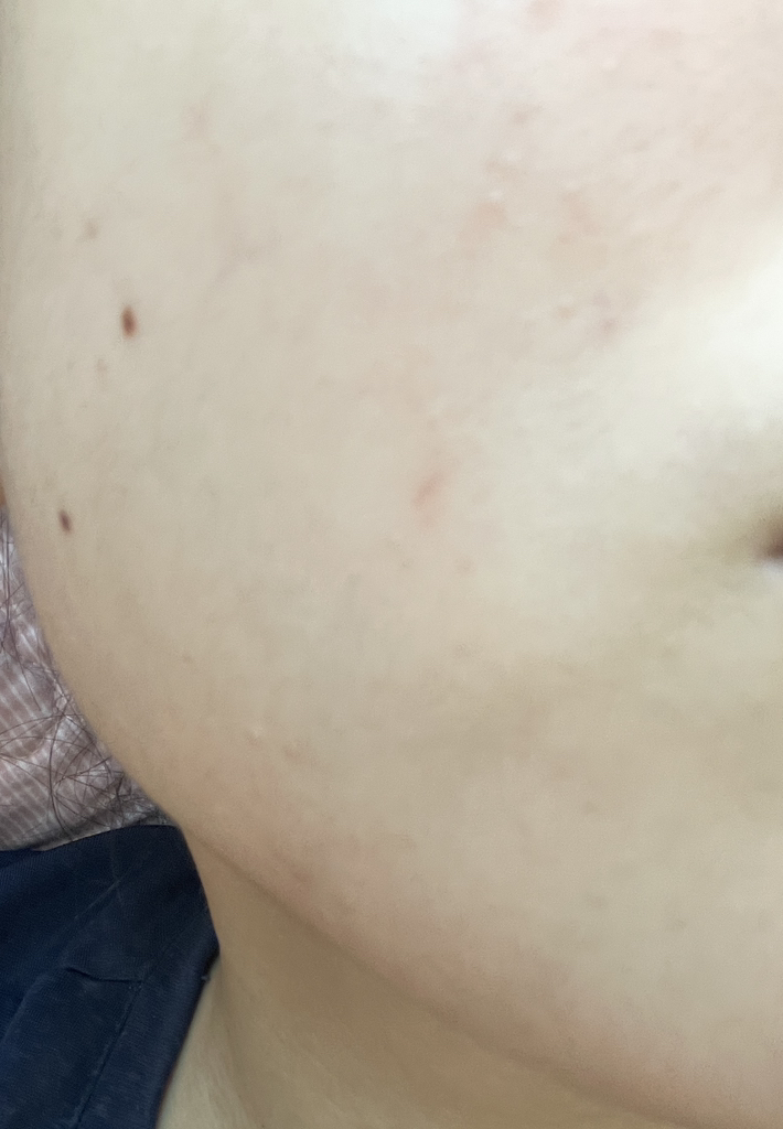 Akne 沙棘泡沫洁面乳的真实用户使用照片