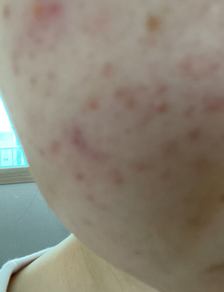 鱼草斑点垫凸轮触感的真实用户使用照片