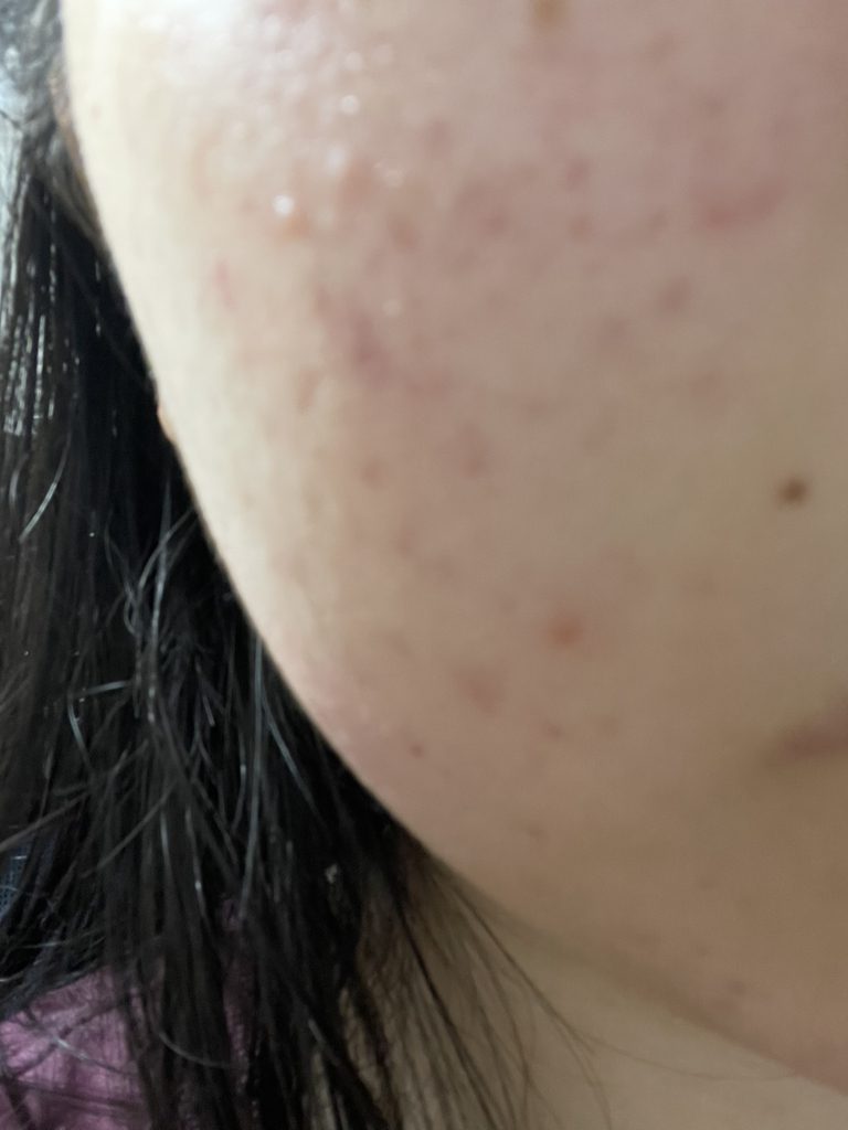 鱼草斑点垫凸轮触感的真实用户使用照片