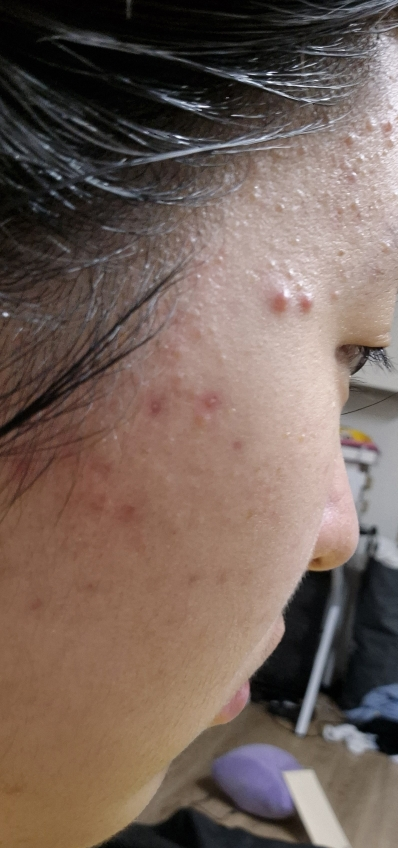 Ảnh đánh giá thực tế của người dùng về Terakne 365 Active Serum