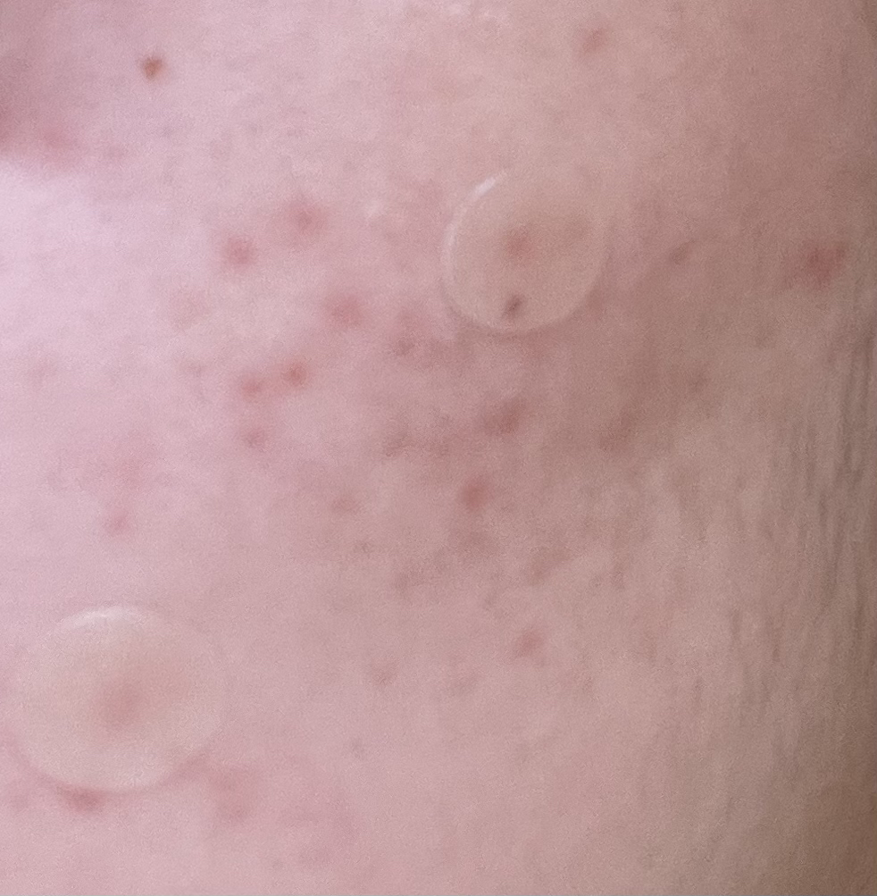 .solution aSolution 暗疮问题化妆棉 review image