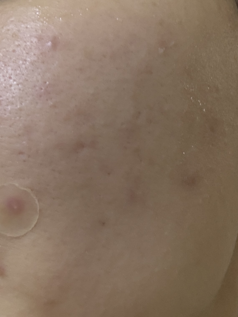 Phyto Lilliputian™ 西卡增效爽肤水的真实用户使用照片