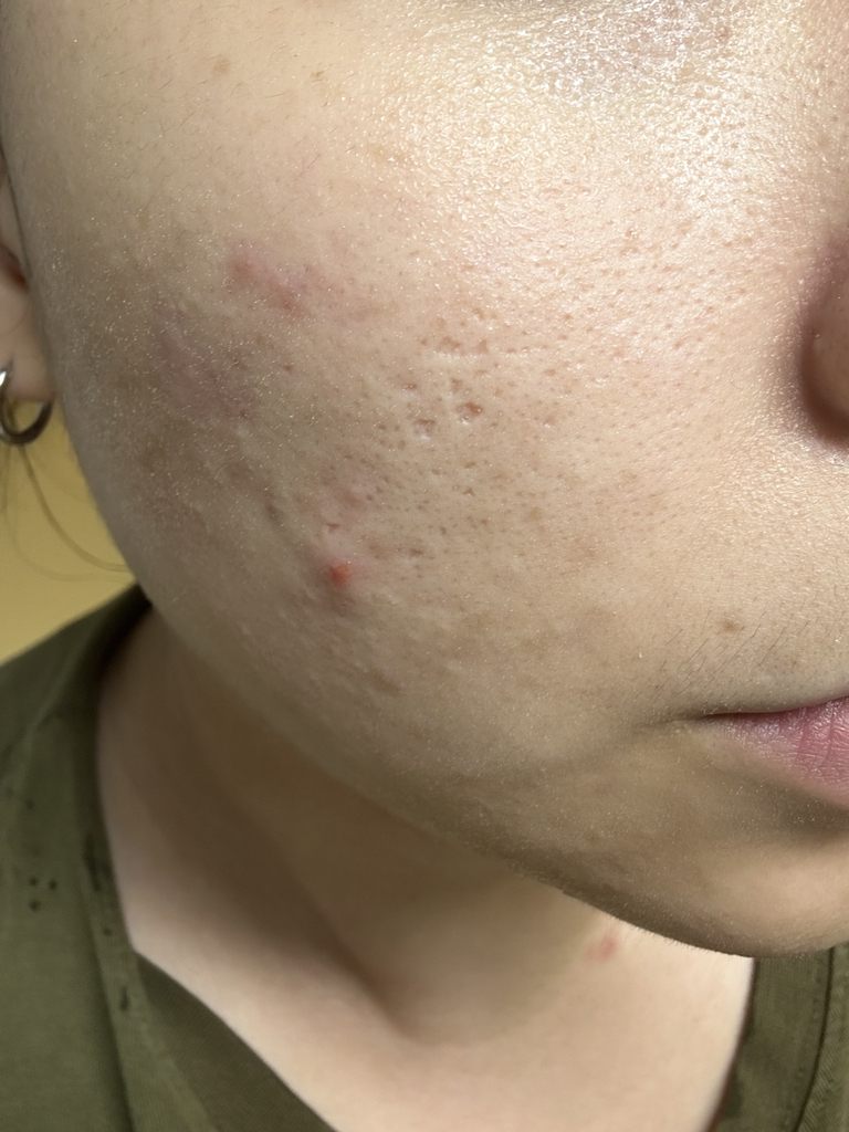 Ảnh đánh giá thực tế của người dùng về Chalttteok Pep Pore Reset Pack Cleanser