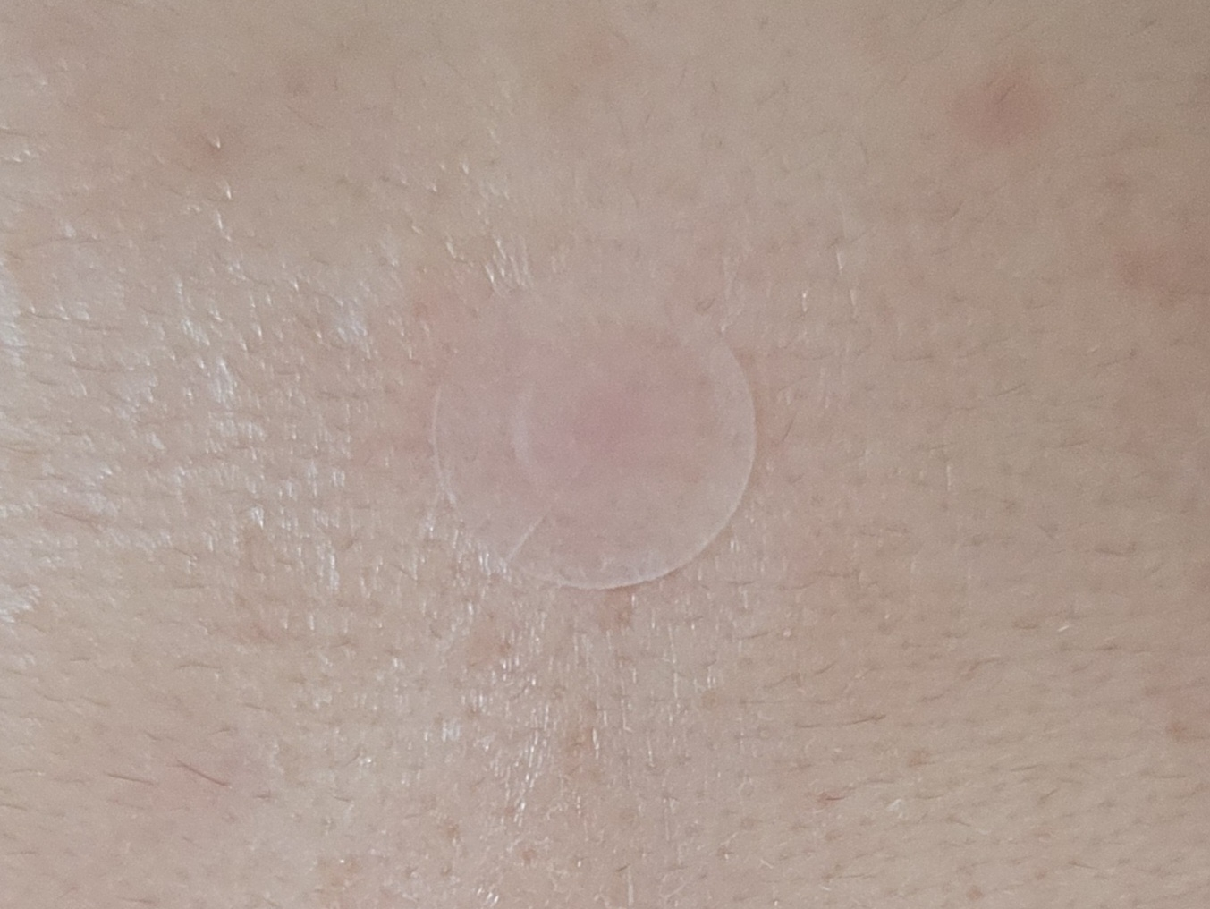 마녀공장 (manyo) 프록실 AC 레스큐 스팟 패치 review image