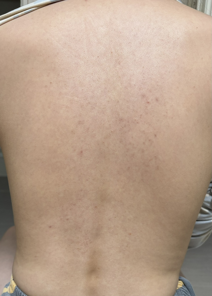 奥尔加博士 弱酸性鱼腥草红斑和痤疮喷雾 common.review image