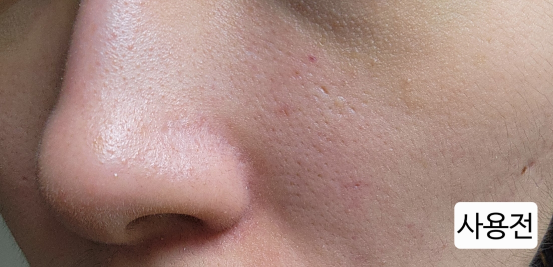 내피부과의사의휴가 (MyDermatologist'sVacation) 마이크로패쓰 꾹탬프 [PDRN] review image