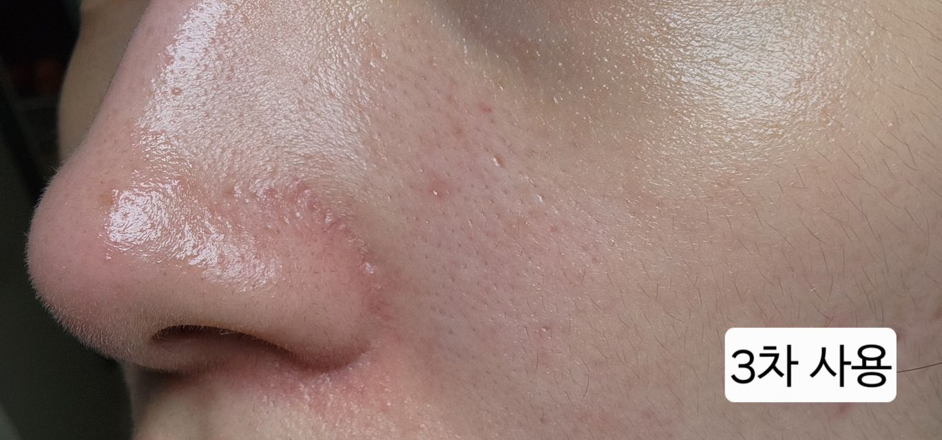 내피부과의사의휴가 (MyDermatologist'sVacation) 마이크로패쓰 꾹탬프 [PDRN] review image