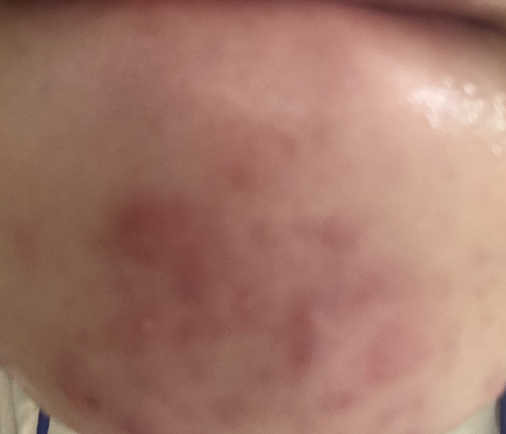 重新平衡故障段 131 安瓿瓶的真实用户使用照片