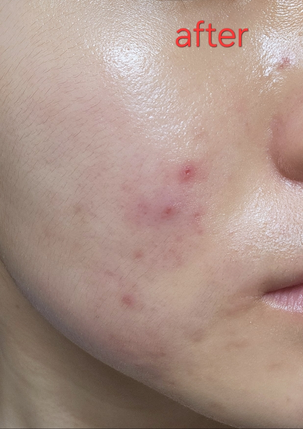 西卡特罗去痘印软膏的真实用户使用照片