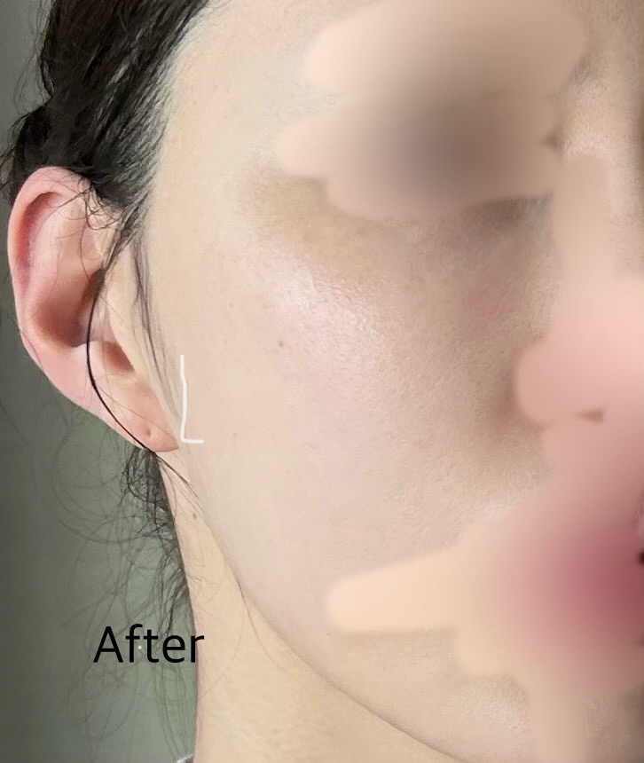 닥터나인틴 (Dr.nineteen) 포어엑스좀 레디알엔 엑소좀 앰플 review image