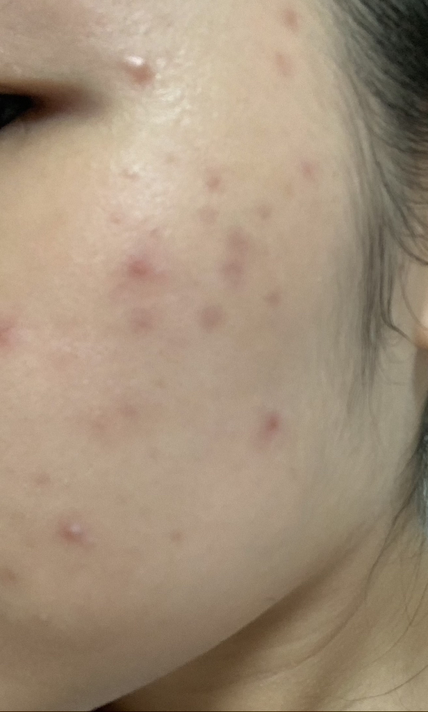 麦地卡索苷微量修复精华素的真实用户使用照片