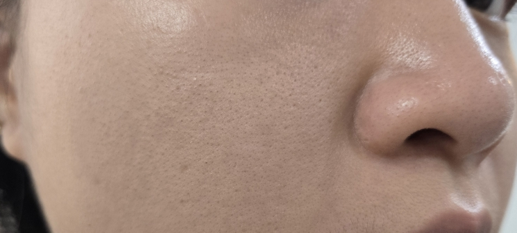 Ảnh đánh giá thực tế của người dùng về Trị mụn và cân bằng da 131 ống