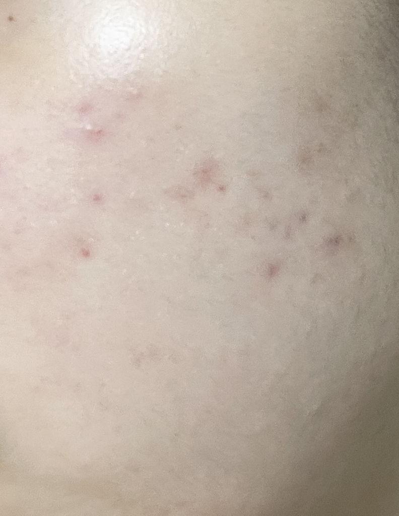 아누아 (Anua) 어성초 센텔라 레드 스팟 크림 review image