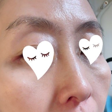 beplain Ampoule of cicaterol review image