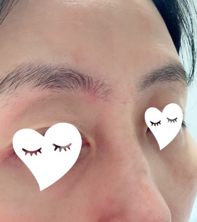 beplain Ampoule of cicaterol review image