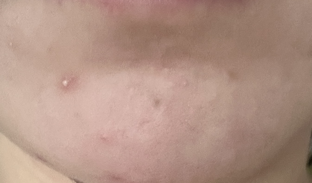 센텔리안24 (CENTELLIAN24) 마데카 분말 티트리 에이씨 review image