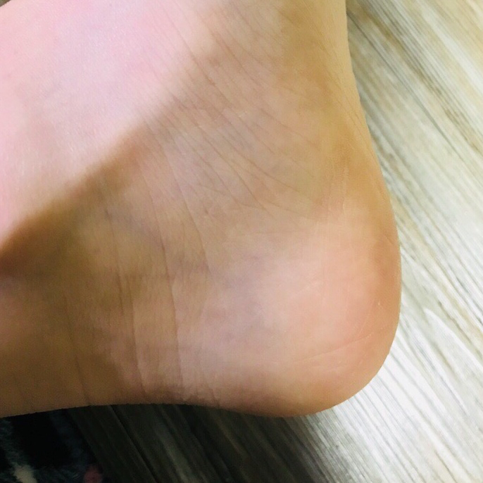 フットケアスティックのリアルなユーザー写真